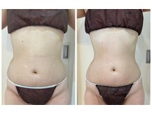 エイシスグロウ(asis glow.)/効果写真