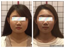 堺整骨院 小郡院/小顔矯正