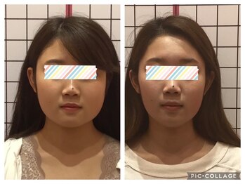 堺整骨院 小郡院/小顔矯正