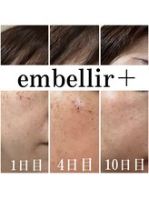 アンベリールプラス(embellir+)/お肌のお悩みは今日で最後