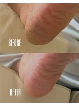 おん/かかとのガサガサ