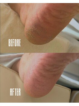 おん/かかとのガサガサ