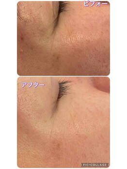 サロンドラニ(salon de LANI)/【プラズマフェイシャル】症例