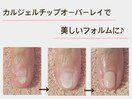 カルジェルチップオーバーレイ