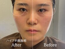 ルーミー 南青山(LUME)/頬～眉までリフトアップ