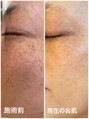 ケイサロン(K salon)&nbsp;シミケアはシミだけでなく肌質も改善していきます！