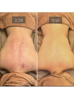 エービューティーサロン 松山店(A BEAUTY SALON.)/30代女性 スマホ首・肩こり