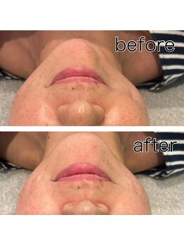 レイモード(Ray mode)/BBLフェイシャル&パック