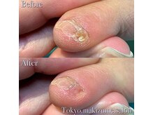 巻き爪補正店　豊橋店【巻き爪・魚の目・角質・副爪】【5月上旬オープン（予定）】/副爪