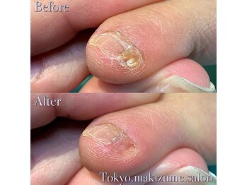 巻き爪補正店 豊橋店【巻き爪・魚の目・角質・副爪】【5月上旬オープン(予定)】/副爪