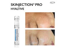 アズール 春日井店(AZURE)の雰囲気（【エステ版ポテンツァ】水分補給/毛穴/ニキビ/凹凸/たるみ/シワ）