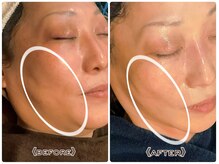 オプス ライフビューティー(OPS×LIFE BEAUTY)/リフトアップ・二重あご解消