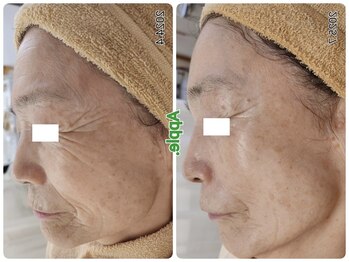 アップル 宇都宮店(Apple.)/肌改善プログラム