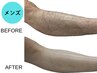 【男性ご新規様限定】メンズ光脱毛VIO含む下半身全部脱毛44,000→22,000