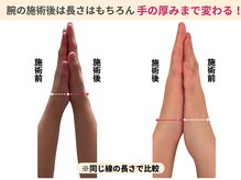 ラルーエ 仙台/手の癒着は肩こりの原因に！