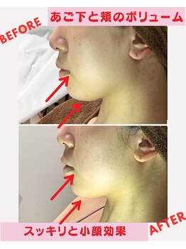 ユーフォリア(Euphoria)/あご下のボリューム、すっきり!