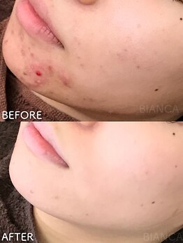 ビアンカ/ニキビ、赤みケア
