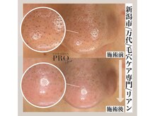 リアン(Riant)/毛穴ケアコース 