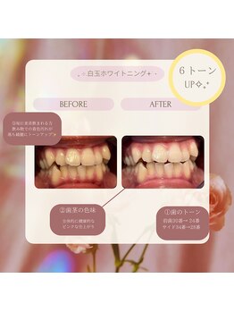 プラスビー 2号店(+b)/ホワイトニングビフォーアフター