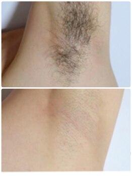 ミラ(Mira)/ワキ脱毛