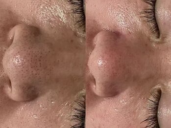 健康美 東洋医学療法院 鴻巣店/美らくる吸引療法