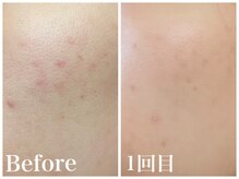 ノア 新宿(Noa)/ハーブピーリング＋マシン 3回