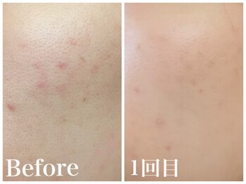 ノア 新宿(Noa)/ハーブピーリング+マシン 3回