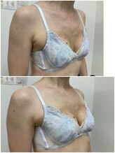 バーディー(BIRDIE)/施術3回/50代/AA→B