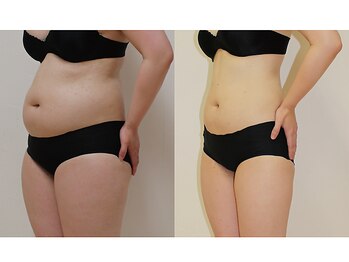 カブール 姫路店/インドエステお腹