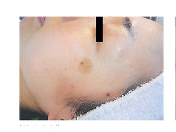 ウル(Ulu)/【シミ改善・予防】クリアなお肌