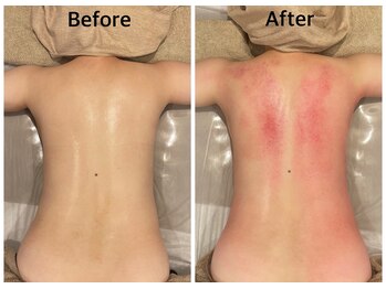 エニ 恵比寿(eni)/背中のビフォーアフター