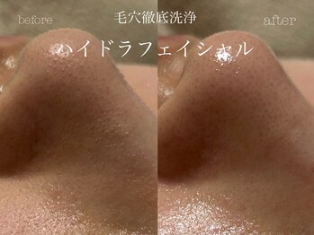 キアラ(CHIARA)/ハイドラフェイシャル