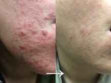 エミナル(eminal)/ビフォーアフター/ニキビ/梅田