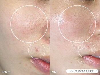 フォンビューティー(fon beauty)/ニキビ×赤みケア1回