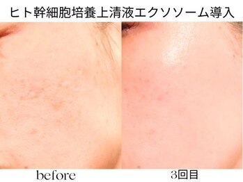リジェネラティブセル メディカルサロン(Regenerative Cell Medical Salon)の写真/注目の日本初3種混合エクソソーム導入!毛穴・たるみ・シワ・シミ・乾燥へアプローチ◎土台から肌質改善!