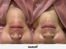 ナルムフェイシャル 代々木(NARUM facial)/水光ピール
