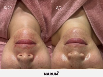 ナルムフェイシャル 代々木(NARUM facial)/水光ピール