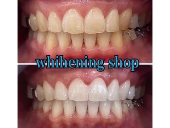 ホワイトニングショップ 長岡京店/ホワイトニングビフォーアフター