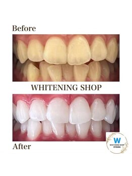 ホワイトニングショップ 小山店/【ビフォーアフター】