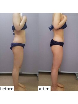 アップルミント/＜痩身＞before・after