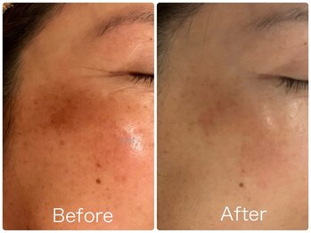 リュウ鍼灸院 サロン ド リュウ(Salon de Ryu)/シミケアでの改善例