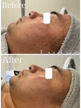 ルノン(Lunon)/毛穴洗浄ハイドロ×ララピール