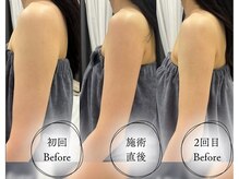 話題のレモンボトル導入！/痩身/王子/レモンボトル