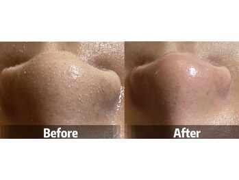 ルミナエステ(LUMINA ESTH)/毛穴/毛穴洗浄/毛穴ケア|症例