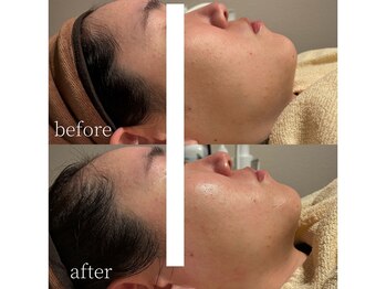 コモレビ(komorebi)/町田駅/フェイスワックス/顔脱毛