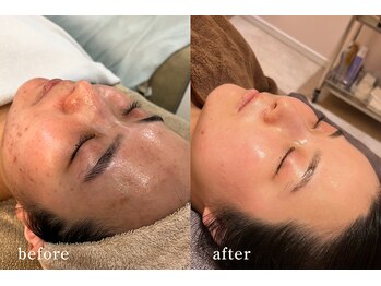 サロンムーン 赤坂(salon moon)の写真/【肌トラブル改善 /完全オーダーメイド施術】結果重視×1人ひとりに寄り添った本気の根本肌質改善ケア◎