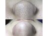 【毛穴大掃除セット】長年の黒い毛穴詰まり1度でスッキリ/8800→6600