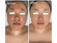 ディアンヌ(Diane)/小顔/赤み肌/二重あご/骨盤矯正