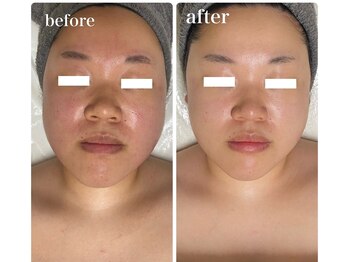 ディアンヌ(Diane)/小顔/赤み肌/二重あご/骨盤矯正