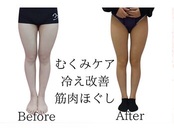 医療提携サロン/落ちにくい太ももの脂肪をケア